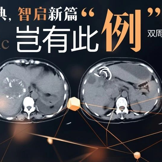 岂有此 “例”丨结直肠癌多发肝转移怎么办？小编带您回顾MDT讨论实录