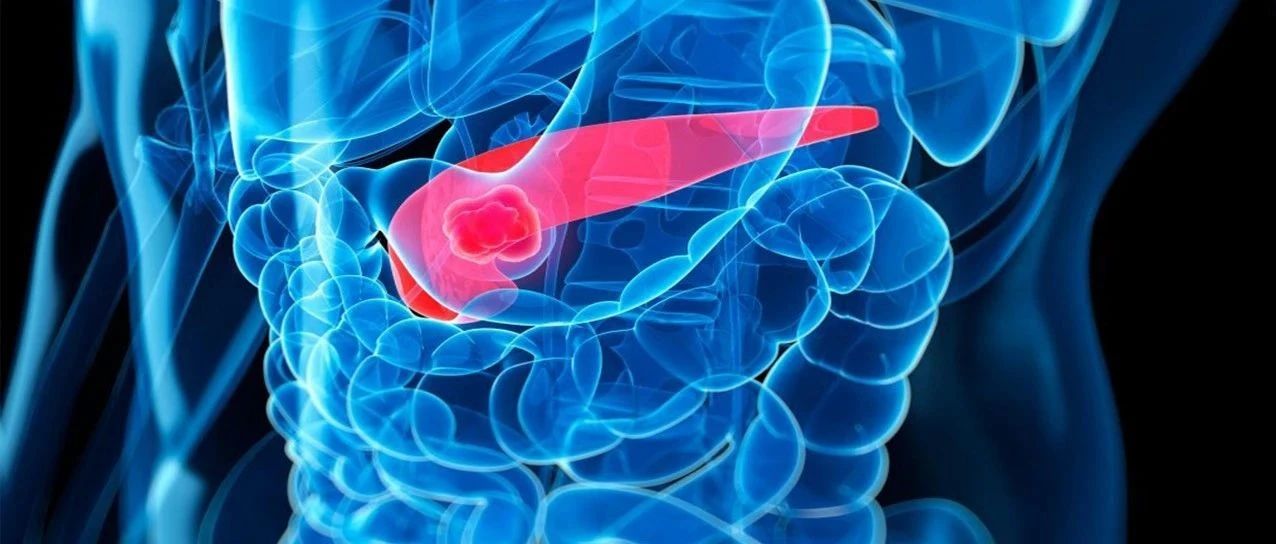 现代化疗时代，术后切缘阳性的胰腺癌患者生存：仍能获益吗?