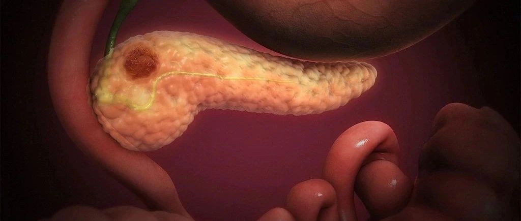 PARP抑制剂能否在BRCAness表型胰腺癌中扩大应用？