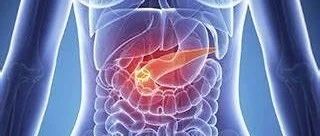 为什么胰腺导管腺癌如此致命？答案在这里