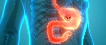 3年更新数据证实：S-1+多西他赛对Ⅲ期胃癌确有益处